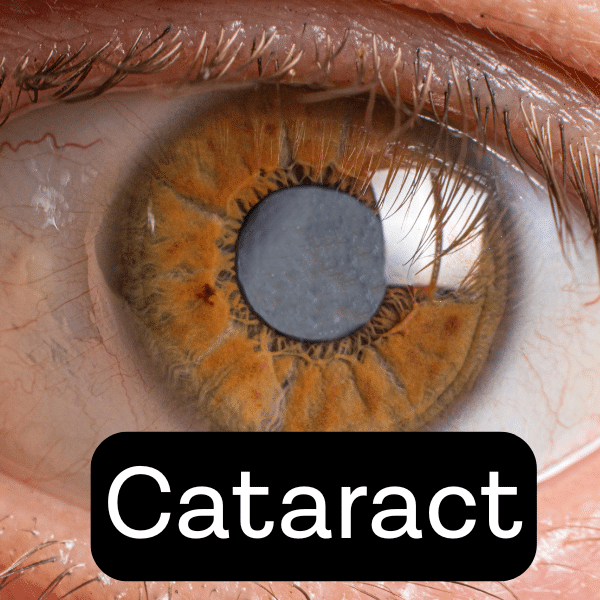 Eye with a cloudy cataract