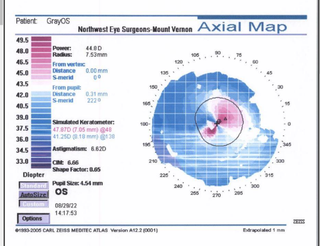 Corneal Topography of Pediatric Blepharokeratoconjunctivitis
